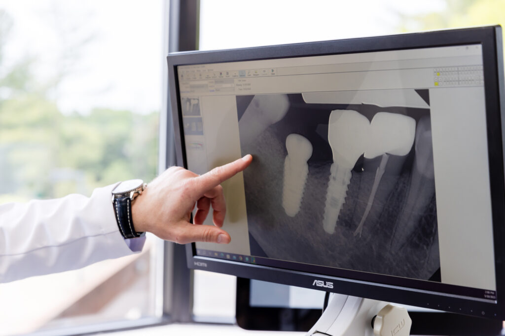 Doctors explain the procedure with clear X-Rays for Fillings and Crowns in Fairfax