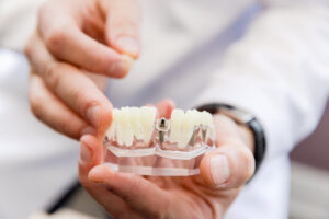 Dentist holding a mouth piece to explain how our dental implants in Fairfax work.