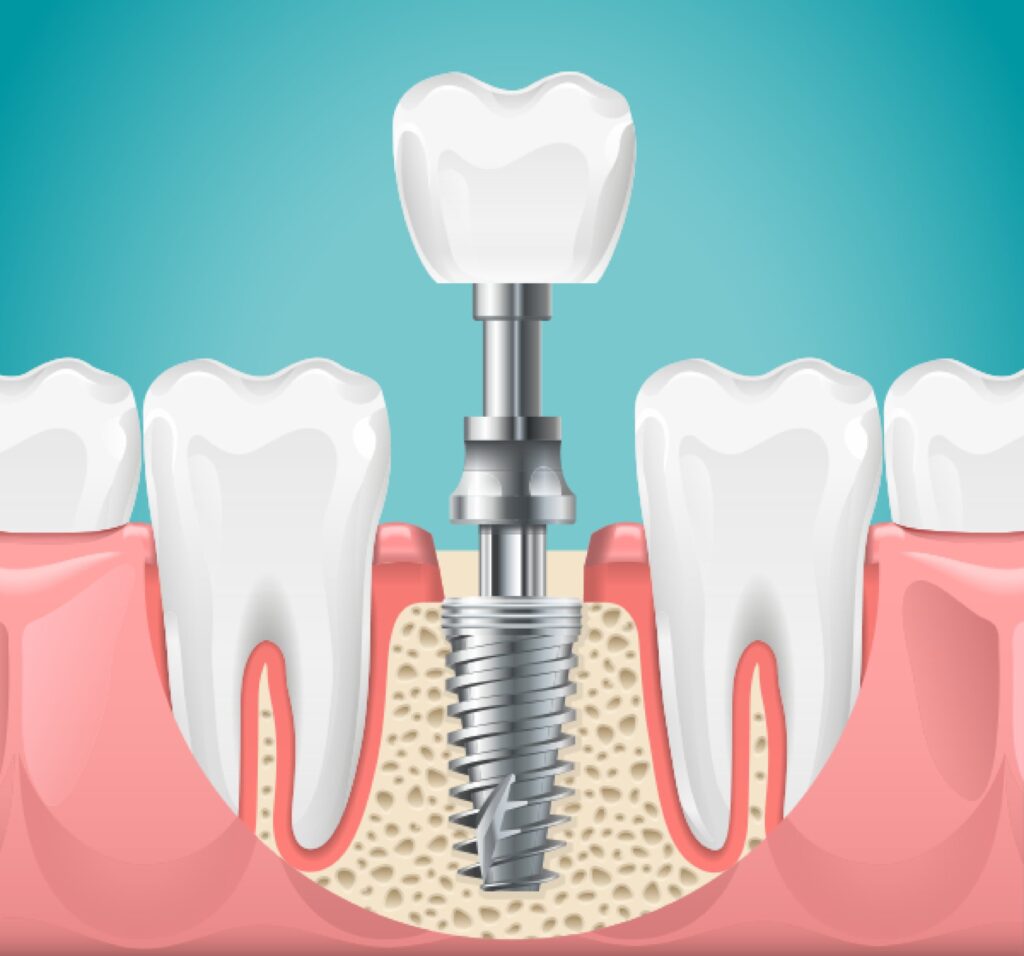 Illustration of how dental implants work.