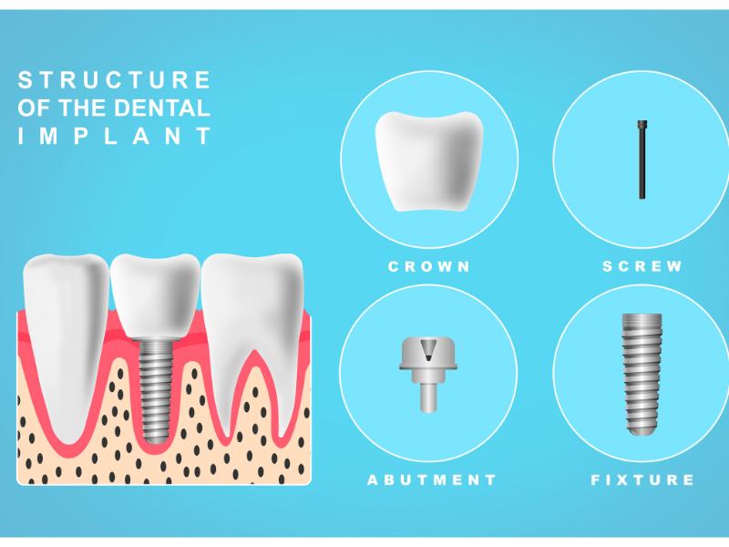 An illustration showing the structure of a dental implant