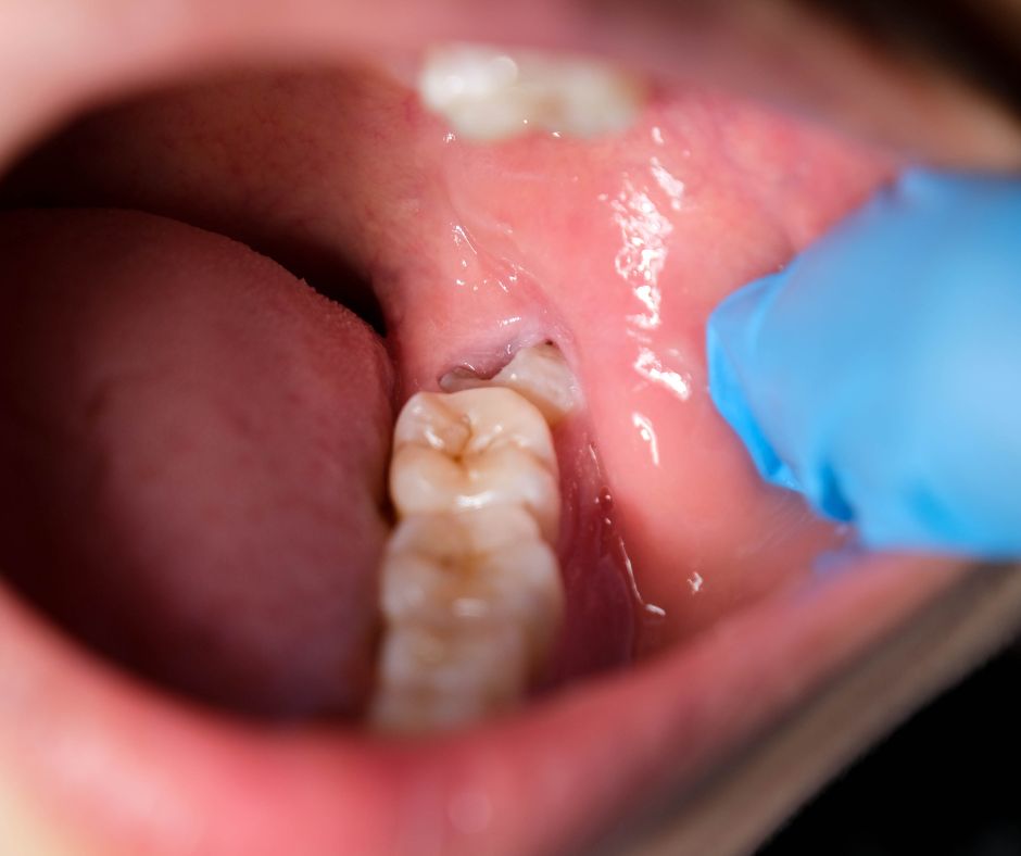 Oakton Family Dentistry - Best Dentist for Wisdom Tooth Removal Near Me