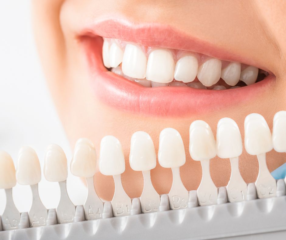 Oakton Family Dentistry - Teeth Whitening Fairfax