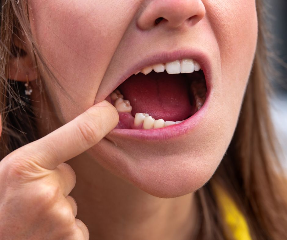 Oakton Family Dentistry - Dental Bridge in Fairfax, VA