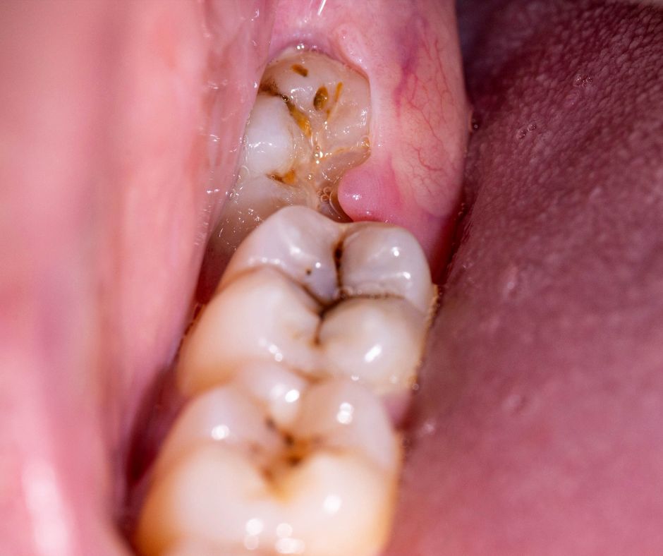 Oakton Family Dentistry - Impacted Teeth Fairfax VA