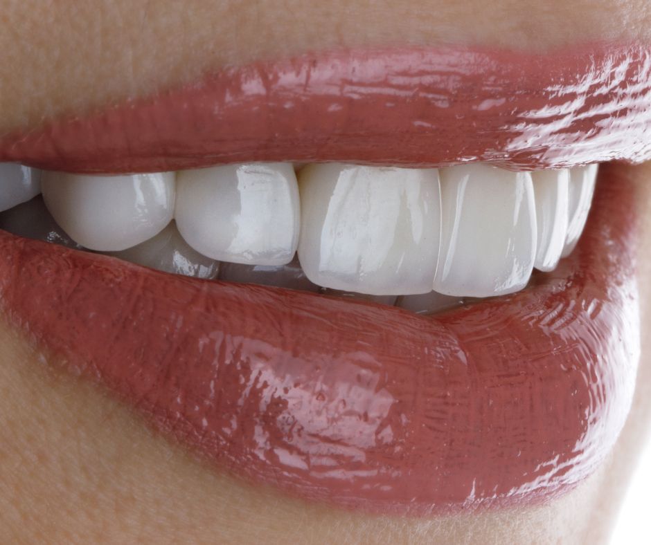 Oakton Family Dentistry - Veneers in Fairfax VA