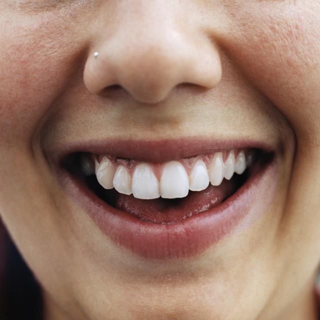 Oakton Family Denitstry - Dental crowns in Fairfax, VA