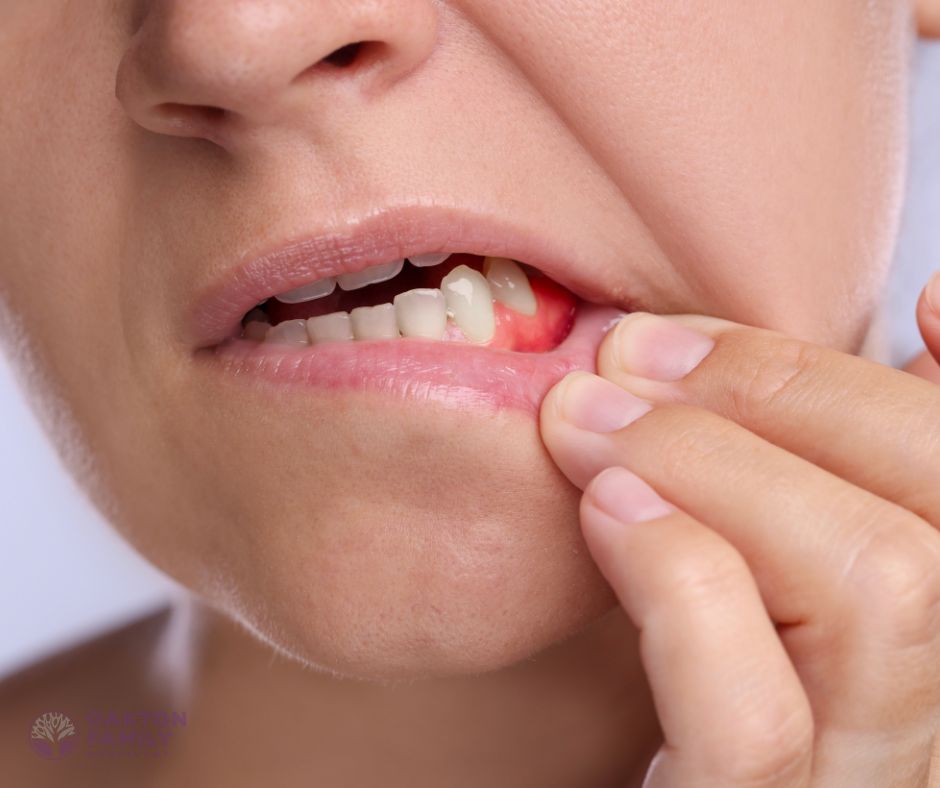 Oakton Family Dentistry - Bleeding Gums Treatment Northern Virginia