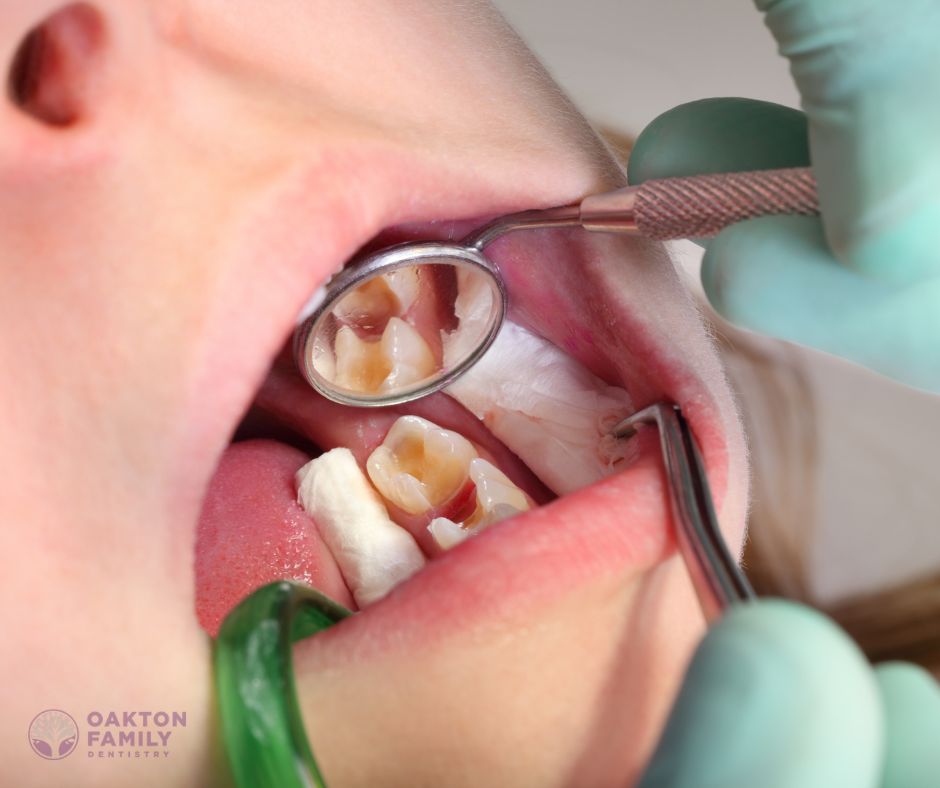 Oakton Family Dentistry - delaying dental fillings in Fairfax VA