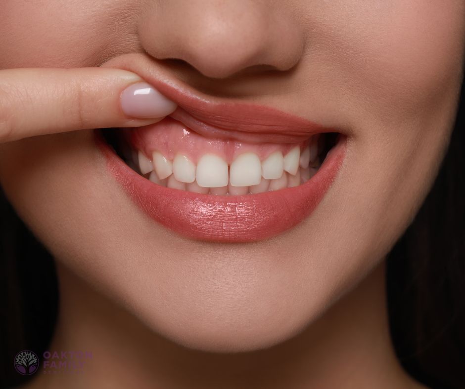 Oakton Family Denstistry - sore gums after dental cleaning Fairfax, VA