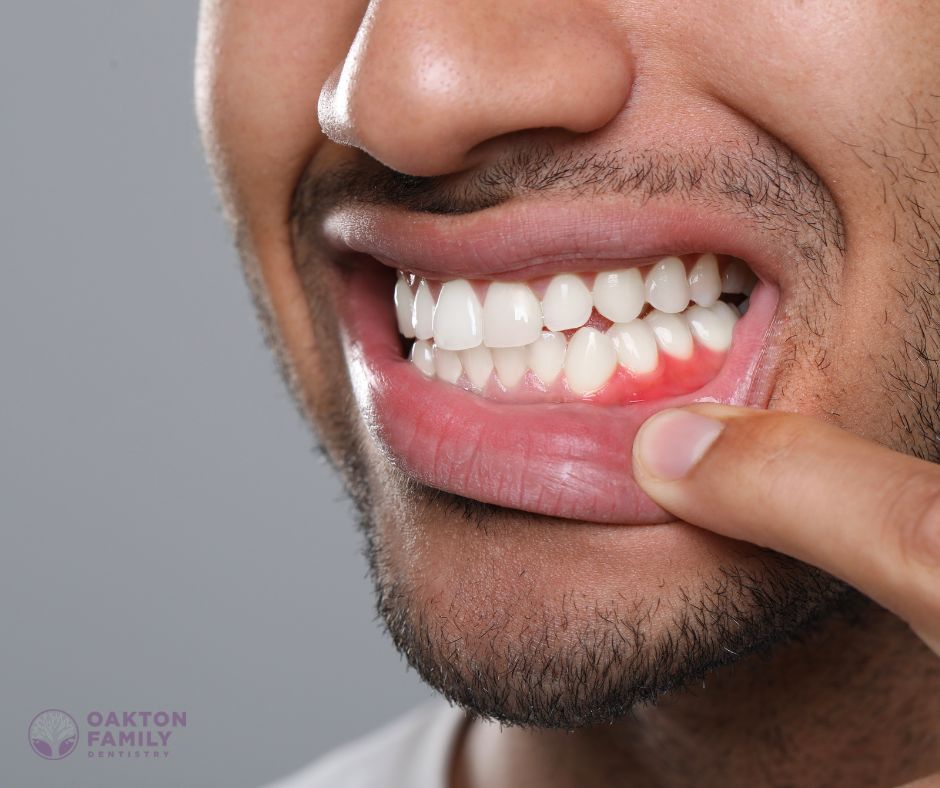 Oakton Family Dentistry - Gum Recession Treatment in Fairfax VA